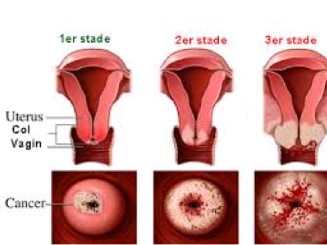 Condylomes : Le cancer du col de l'utérus, le risque le plus ...